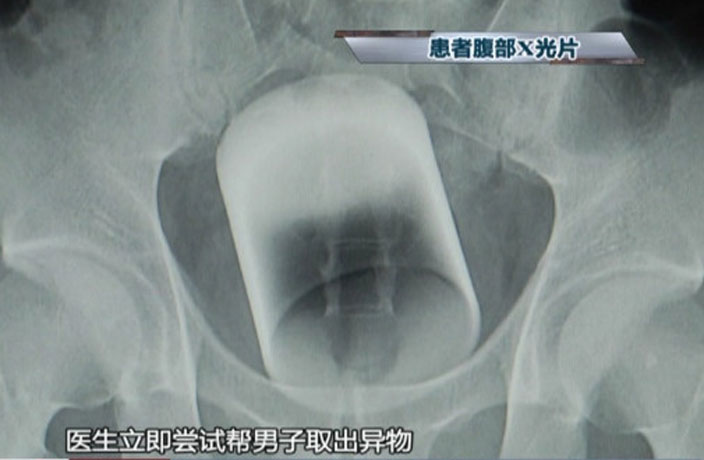 Man Gets Glass Cup Stuck in Ass in Guangzhou, Requires Surgery – That's  Guangzhou